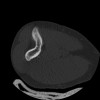 SPORK, NICO - 22.03.1976 - 02.08.2022 - CT obere Extremität - 17:51:17